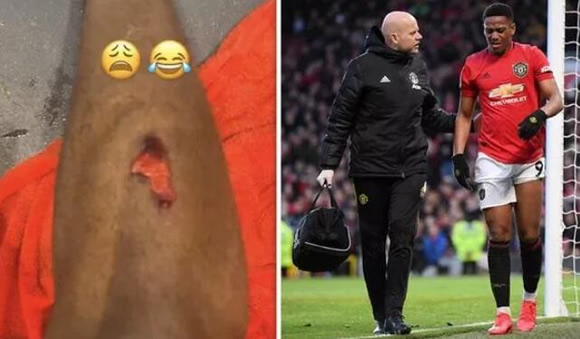 Man Utd star Anthony Martial shares gruesome snaps of bloody injury after Man City win