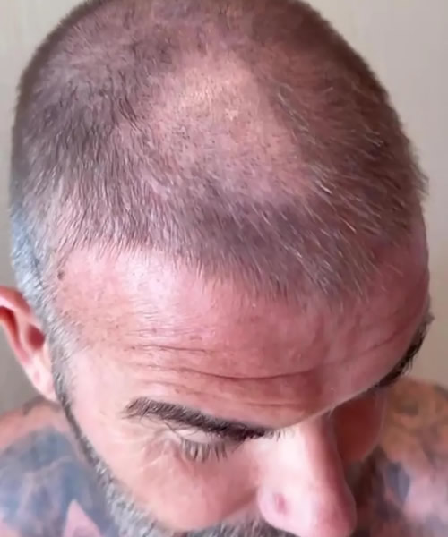 becks' blunder David Beckham is left with a huge BALD patch after DIY haircut blunder – and wife Victoria admits ‘it looks terrible’